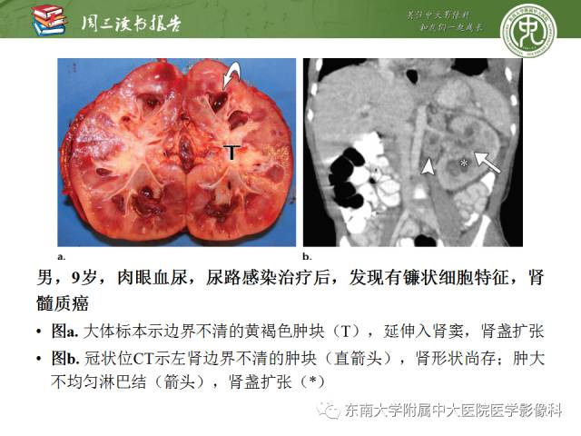 【PPT】儿童肾肿瘤：影像-病理相关性第二部分（10 ~ 20岁）