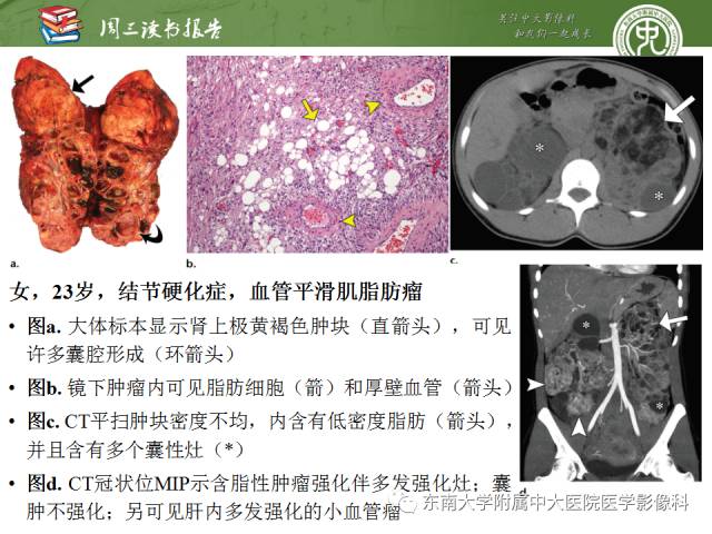 【PPT】儿童肾肿瘤：影像-病理相关性第二部分（10 ~ 20岁）