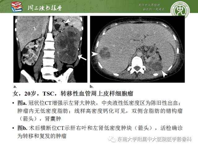 【PPT】儿童肾肿瘤：影像-病理相关性第二部分（10 ~ 20岁）