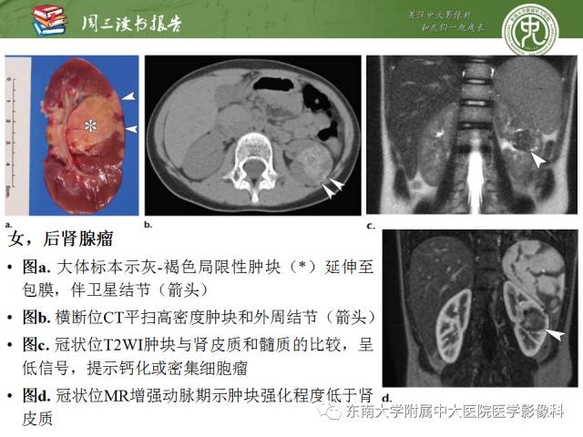 【PPT】儿童肾肿瘤：影像-病理相关性第二部分（10 ~ 20岁）