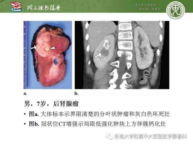 【PPT】儿童肾肿瘤：影像-病理相关性第二部分（10 ~ 20岁）