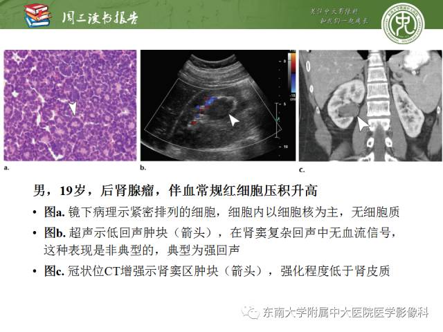 【PPT】儿童肾肿瘤：影像-病理相关性第二部分（10 ~ 20岁）