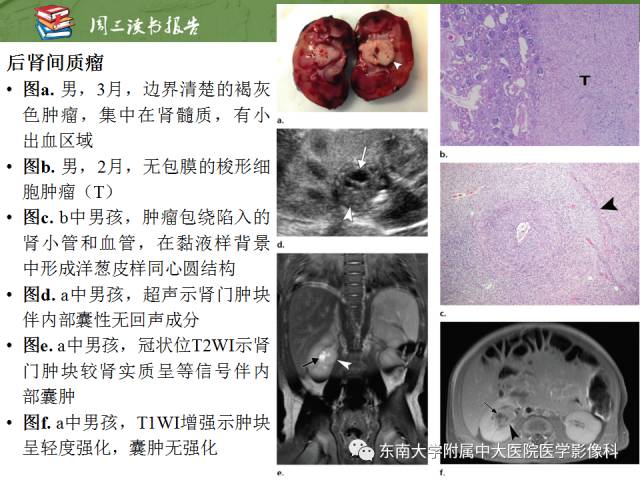 【PPT】儿童肾肿瘤：影像-病理相关性第二部分（10 ~ 20岁）