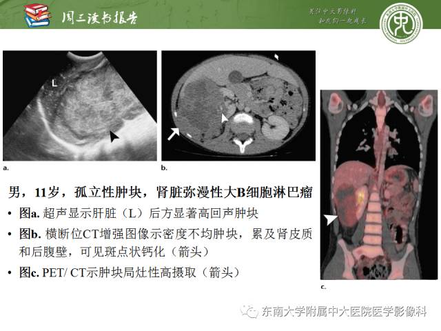 【PPT】儿童肾肿瘤：影像-病理相关性第二部分（10 ~ 20岁）