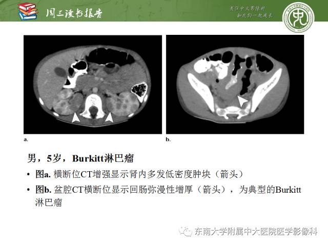 【PPT】儿童肾肿瘤：影像-病理相关性第二部分（10 ~ 20岁）