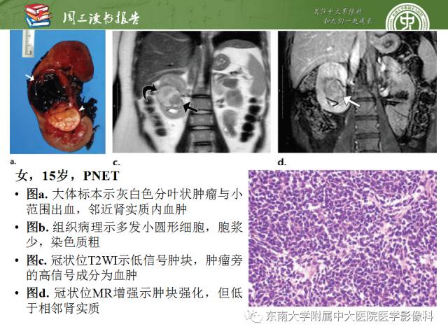 【PPT】儿童肾肿瘤：影像-病理相关性第二部分（10 ~ 20岁）