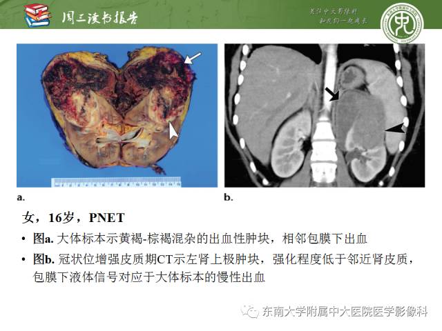 【PPT】儿童肾肿瘤：影像-病理相关性第二部分（10 ~ 20岁）