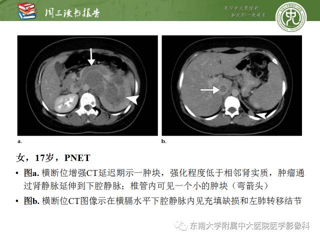 【PPT】儿童肾肿瘤：影像-病理相关性第二部分（10 ~ 20岁）