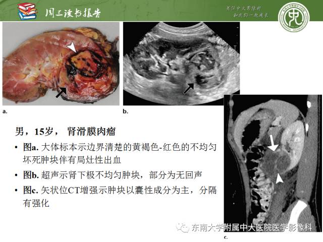 【PPT】儿童肾肿瘤：影像-病理相关性第二部分（10 ~ 20岁）