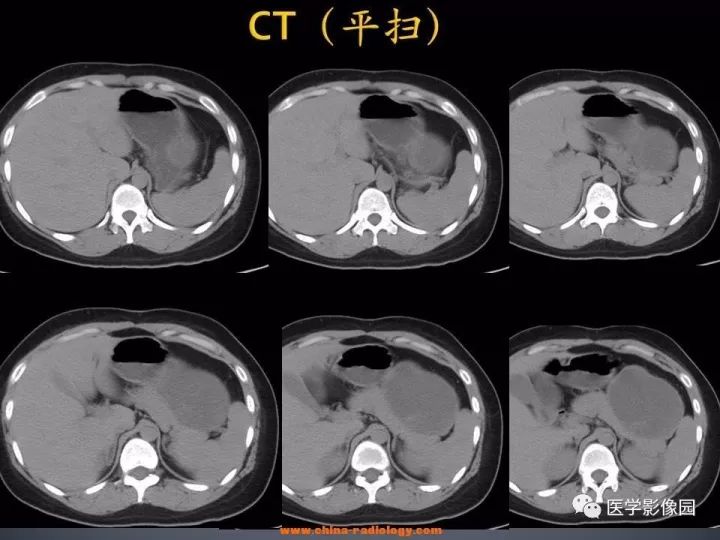 【病例】胰腺实性假乳头状瘤1例CT影像表现