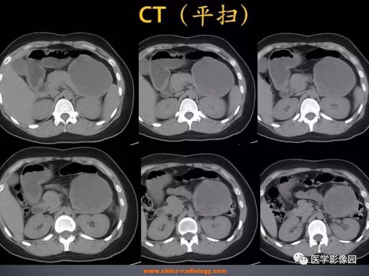 【病例】胰腺实性假乳头状瘤1例CT影像表现