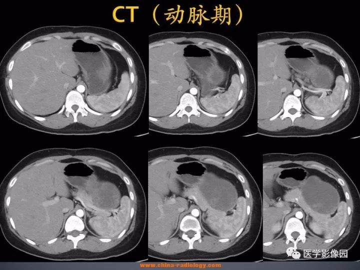 【病例】胰腺实性假乳头状瘤1例CT影像表现
