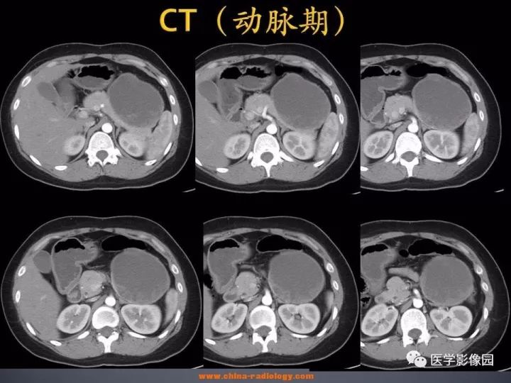 【病例】胰腺实性假乳头状瘤1例CT影像表现