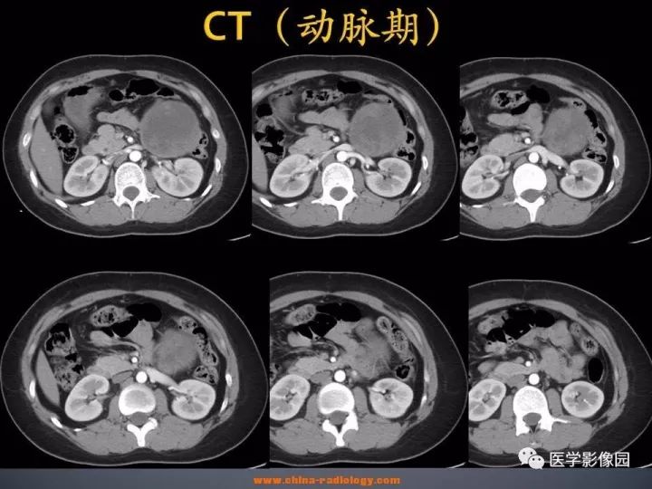 【病例】胰腺实性假乳头状瘤1例CT影像表现