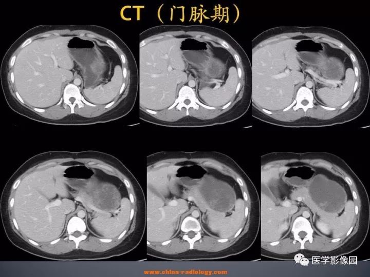 【病例】胰腺实性假乳头状瘤1例CT影像表现