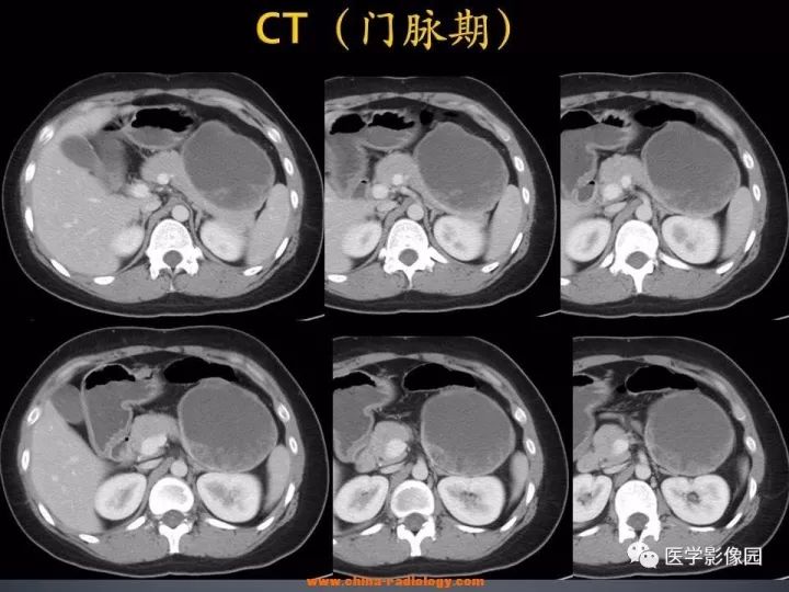 【病例】胰腺实性假乳头状瘤1例CT影像表现