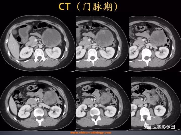 【病例】胰腺实性假乳头状瘤1例CT影像表现