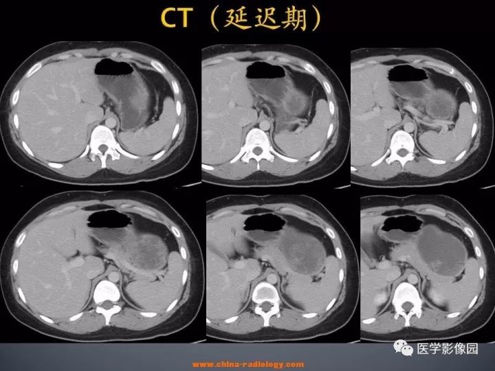 【病例】胰腺实性假乳头状瘤1例CT影像表现