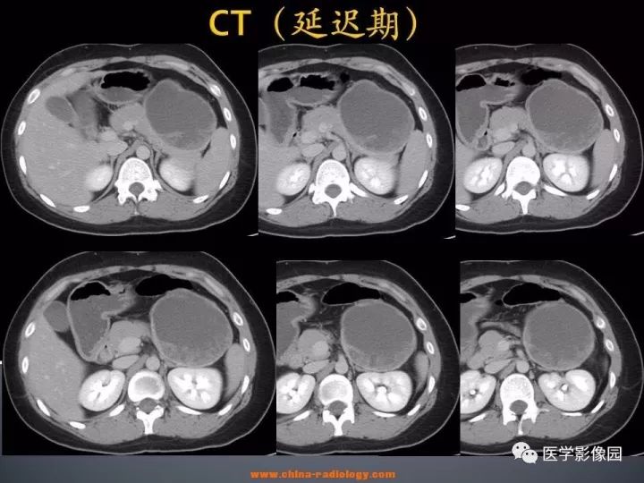 【病例】胰腺实性假乳头状瘤1例CT影像表现