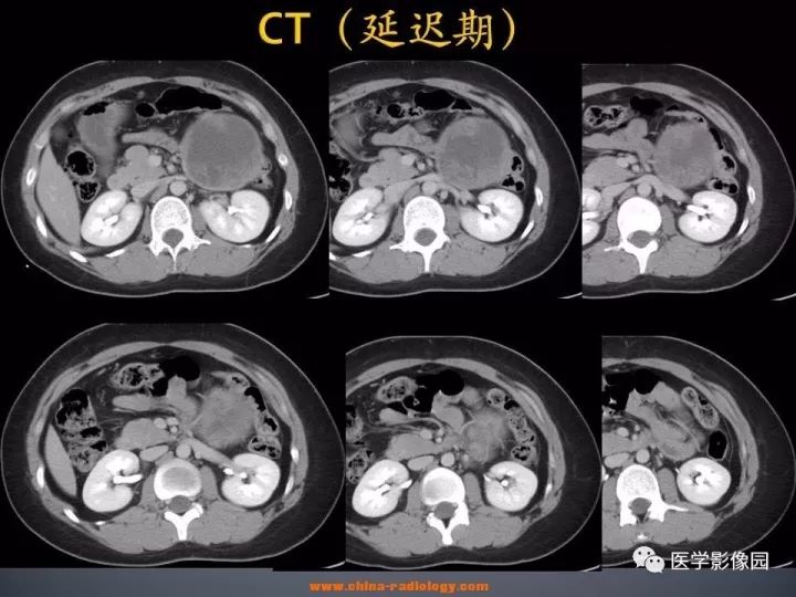 【病例】胰腺实性假乳头状瘤1例CT影像表现