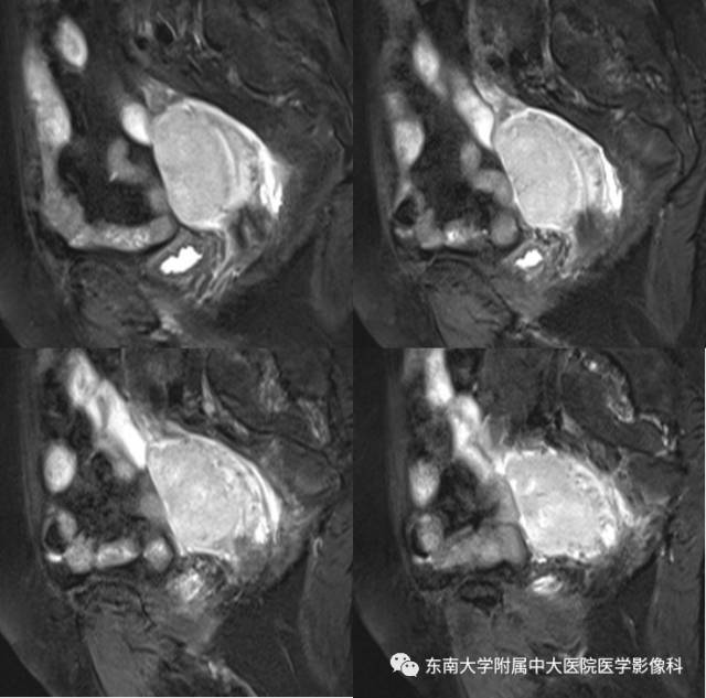 【病例】生殖系统淋巴瘤1例MR影像表现