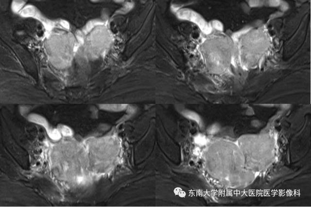 【病例】生殖系统淋巴瘤1例MR影像表现