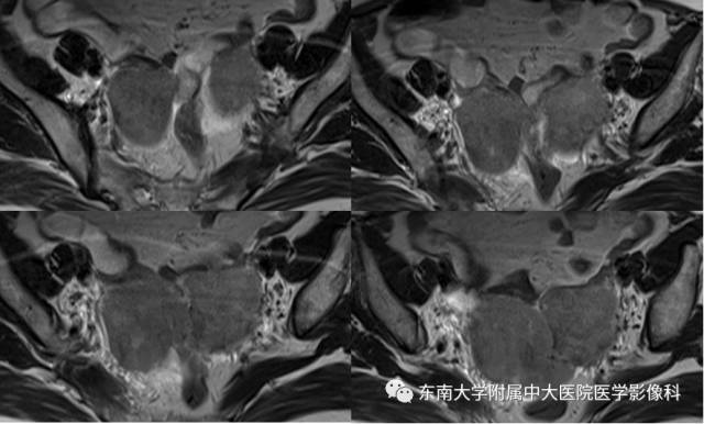 【病例】生殖系统淋巴瘤1例MR影像表现