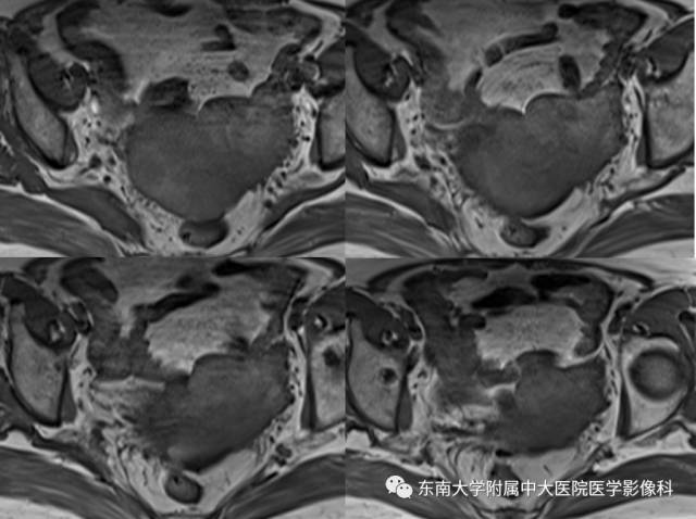 【病例】生殖系统淋巴瘤1例MR影像表现