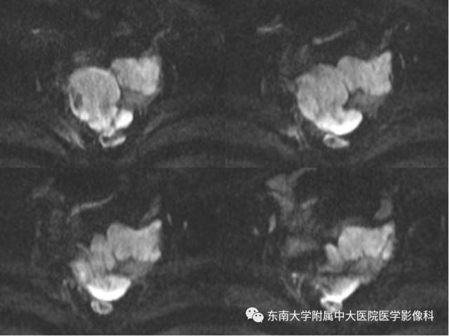 【病例】生殖系统淋巴瘤1例MR影像表现