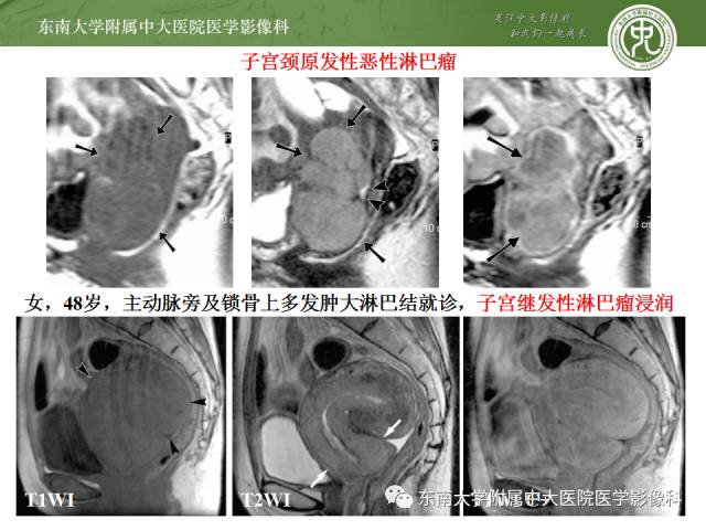 【病例】生殖系统淋巴瘤1例MR影像表现