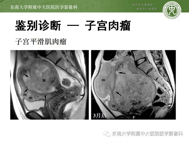 【病例】生殖系统淋巴瘤1例MR影像表现