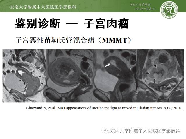 【病例】生殖系统淋巴瘤1例MR影像表现