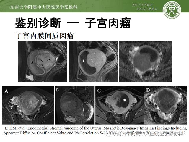 【病例】生殖系统淋巴瘤1例MR影像表现