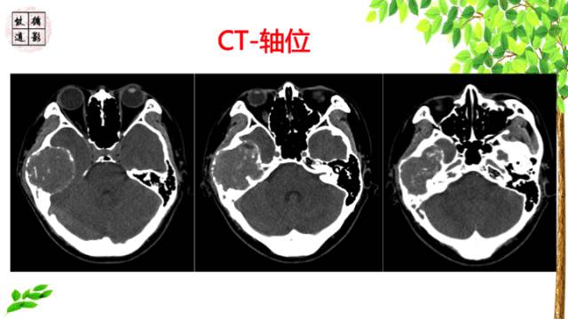 【病例】颞骨骨巨细胞瘤1例CT及MR影像诊断分析