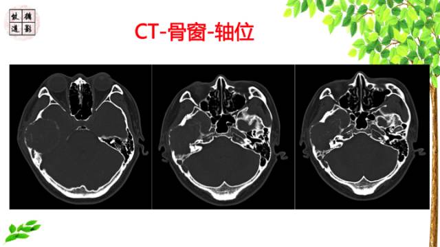 【病例】颞骨骨巨细胞瘤1例CT及MR影像诊断分析