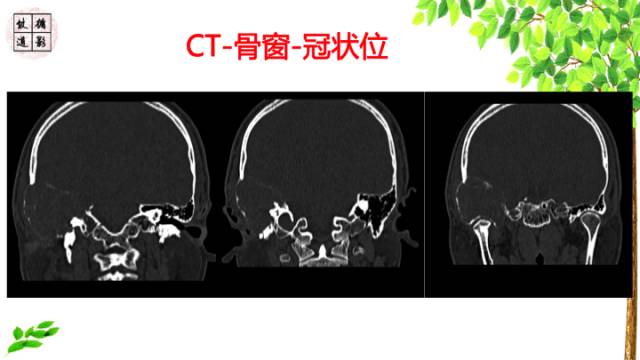 【病例】颞骨骨巨细胞瘤1例CT及MR影像诊断分析