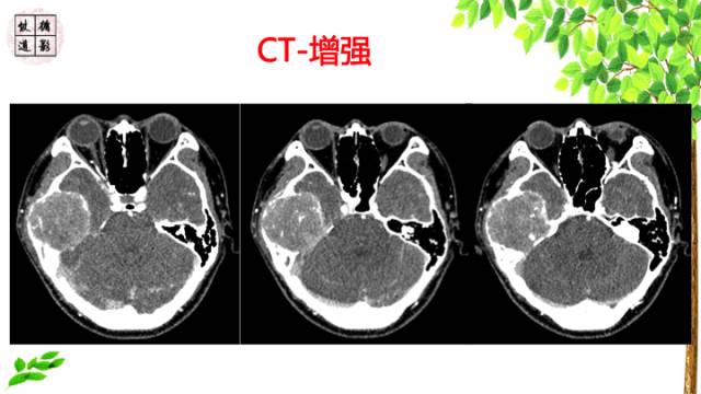 【病例】颞骨骨巨细胞瘤1例CT及MR影像诊断分析