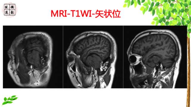 【病例】颞骨骨巨细胞瘤1例CT及MR影像诊断分析