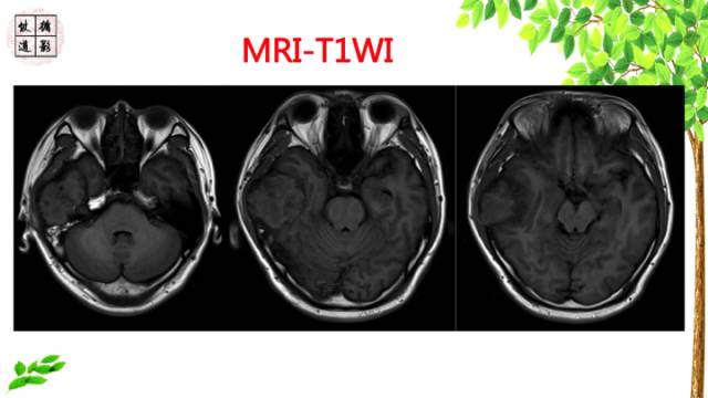 【病例】颞骨骨巨细胞瘤1例CT及MR影像诊断分析