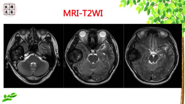 【病例】颞骨骨巨细胞瘤1例CT及MR影像诊断分析