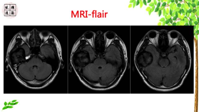 【病例】颞骨骨巨细胞瘤1例CT及MR影像诊断分析
