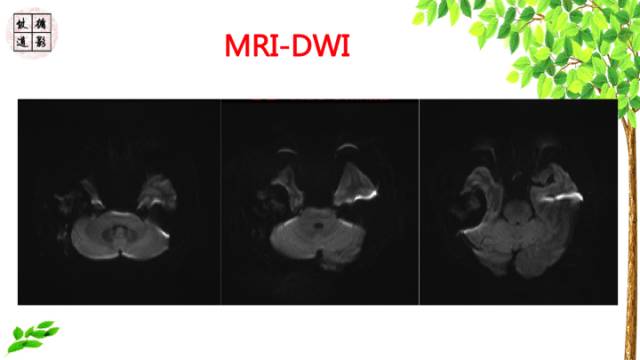 【病例】颞骨骨巨细胞瘤1例CT及MR影像诊断分析