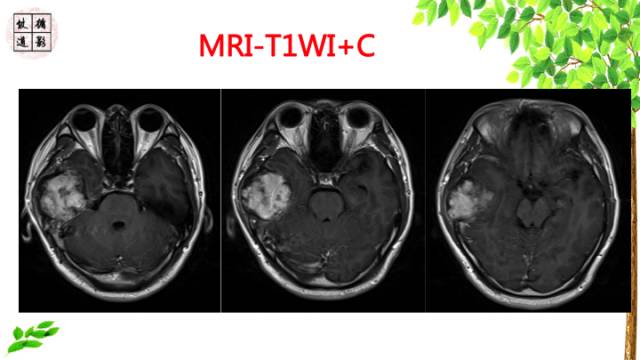 【病例】颞骨骨巨细胞瘤1例CT及MR影像诊断分析