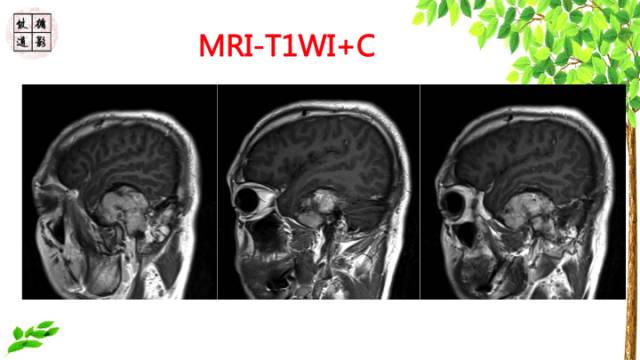 【病例】颞骨骨巨细胞瘤1例CT及MR影像诊断分析