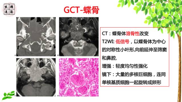 【病例】颞骨骨巨细胞瘤1例CT及MR影像诊断分析
