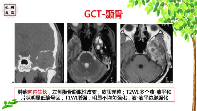 【病例】颞骨骨巨细胞瘤1例CT及MR影像诊断分析