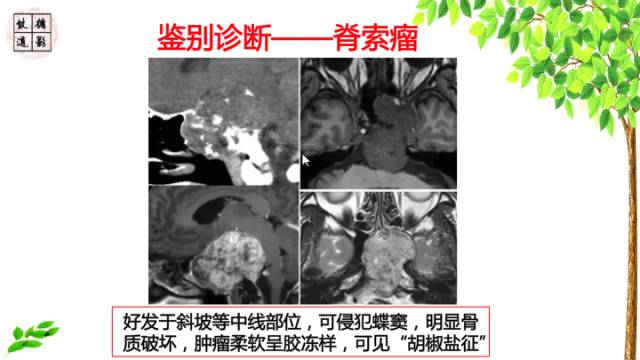 【病例】颞骨骨巨细胞瘤1例CT及MR影像诊断分析