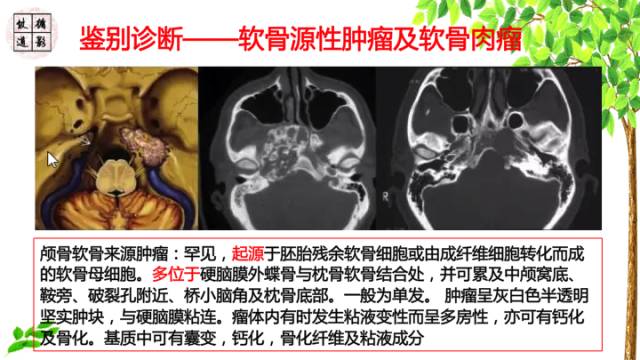 【病例】颞骨骨巨细胞瘤1例CT及MR影像诊断分析