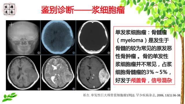 【病例】颞骨骨巨细胞瘤1例CT及MR影像诊断分析