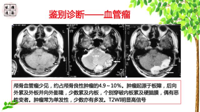 【病例】颞骨骨巨细胞瘤1例CT及MR影像诊断分析